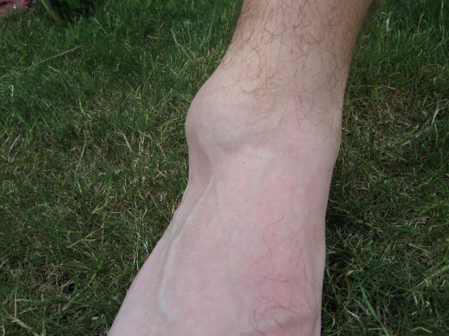 Another view of Brad's ankle